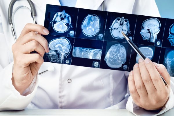 meningite